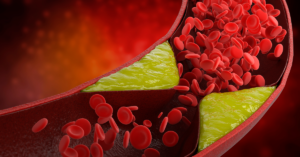 Dislipidemia: Cuide da sua  saúde cardiovascular com  a ajuda do SUS!